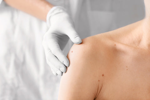 close up image of a dermatologist examining a patient with a skin tag on their shoulder